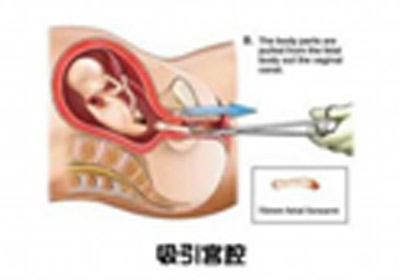 堕胎手术全过程图片