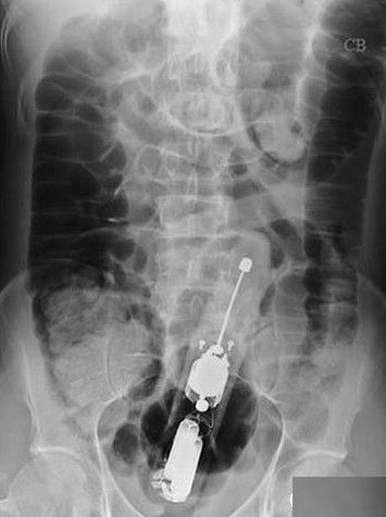 奇异X光片:遗落在身体里异物令人匪夷所思_健康频道_凤凰网