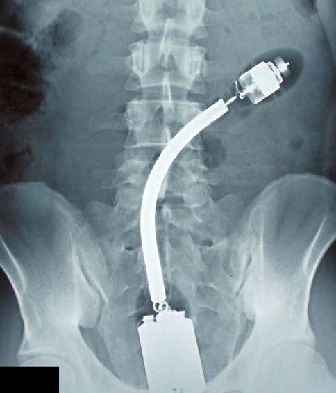 奇异X光片:遗落在身体里异物令人匪夷所思_健康频道_凤凰网