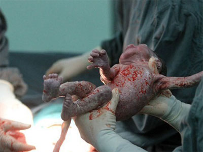 伟大母亲分娩三胞胎全过程图