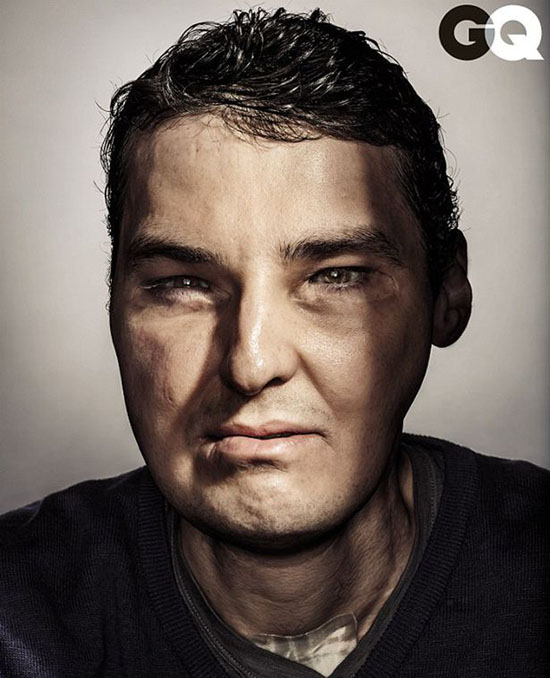 美国男子毁容后做全脸移植手术成时尚杂志封面明星