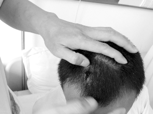 抑郁男将6根钢钉钉入自己脑袋 最深达5厘米(图)