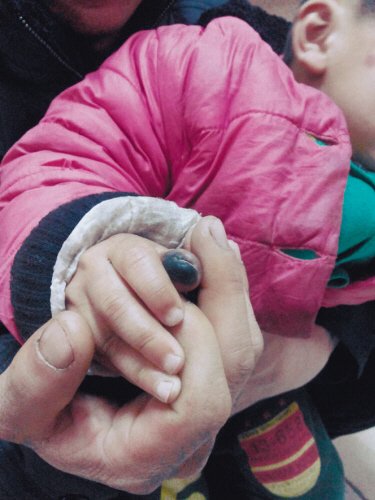 母亲用皮筋包扎孩子伤指 4天绑掉3岁童手指尖