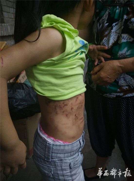 四川一8岁女童长期遭生母殴打屁股肿烂上课无法坐板凳