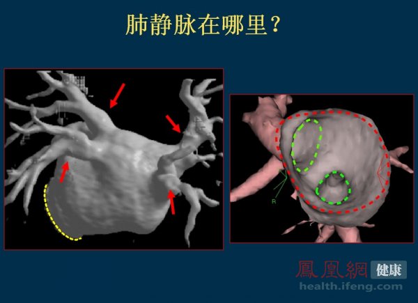医院现场直击房颤导管射频消融术