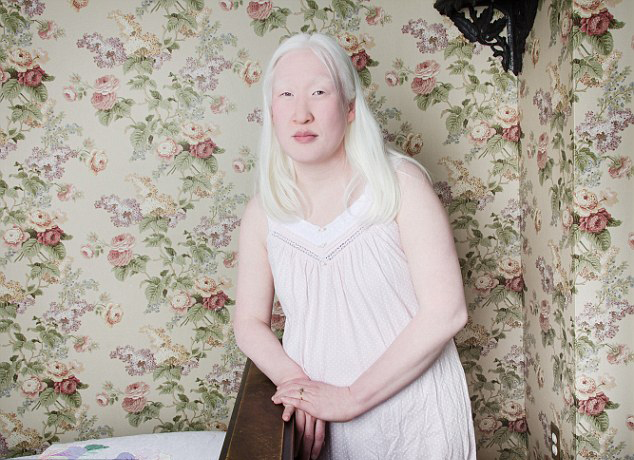 中国白化病人图片