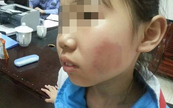 株洲两名小学生公交车上遭陌生女子掐咬(图)