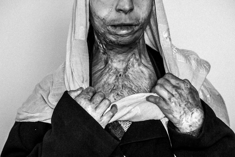 当代热点类组照二等奖:战争下生活的阿富汗人