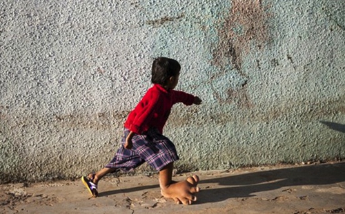 印度4岁男孩患巨腿巨足症右脚重达11斤