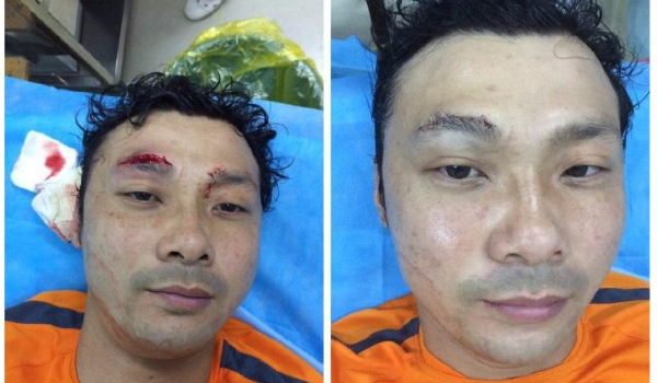 慎点!铁卫飙血眉骨开裂 晒缝针照片力挺鲁能