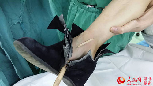 武汉女子穿高跟鞋采摘没站稳被20厘米竹子扎穿脚图