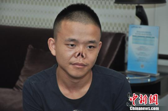 24岁"无鼻男孩"新鼻子成型:新爱好是自拍(图)