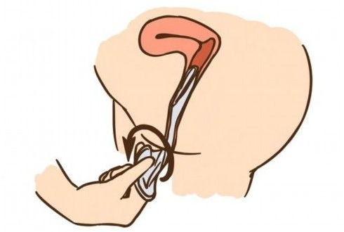 演示女性避孕套的操作使用方法组图