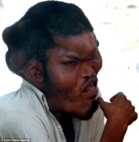 巴基斯坦男子患怪病头部硕大严重畸形(组图)
