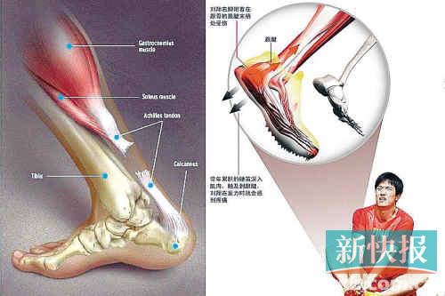 刘翔确诊跟腱两端撕裂